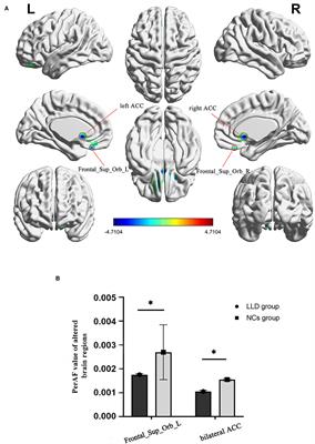 Altered Intrinsic Brain Activity in Patients With Late-Life Depression: A Resting-State Functional MRI Study